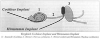 Hirnstamm-Implantat - Grafik 