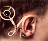 Cochlear Implant